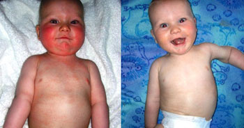 Images Of Infant Eczema